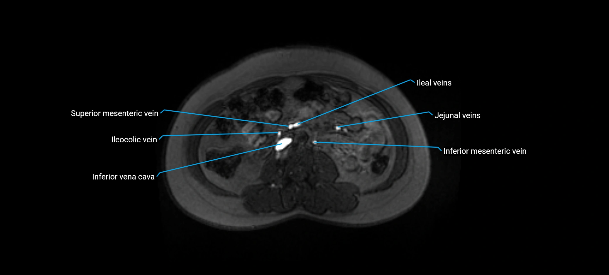 MRV abdomen pelvis & lower limb axial cross sectional anatomy labelled MRI image 90 (1).webp
